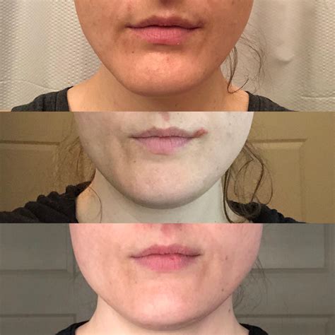 Masseter Botox Photos Before And ~4 Weeks After 15 Units Each Side R Plasticsurgery