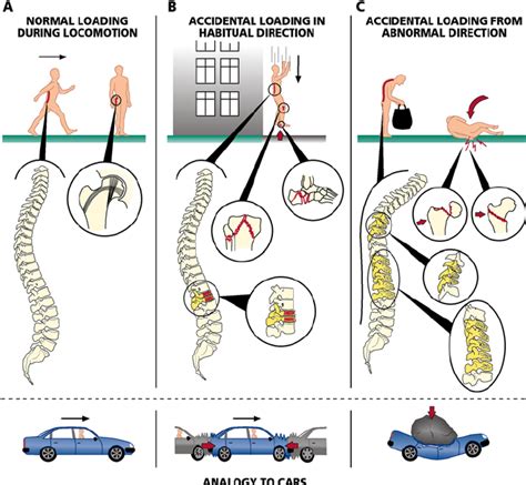 Bone Fractures Car Accidents And Direction Of Impact Download