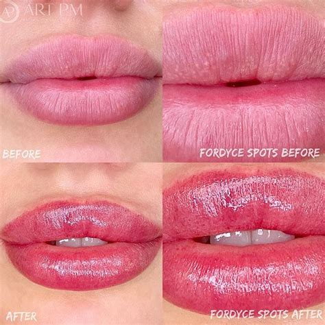 White bumps on lips Have you been noticing some white bumps on your ...