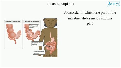 Intussusception Youtube