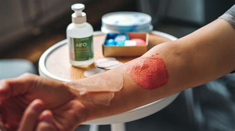 Quick Guide To Treating 1st Degree Burns At Home Pinder Plotkin Llc