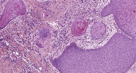 Infiltrating Well Differentiated Squamous Cell Carcinoma Shows