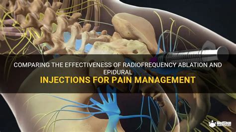 Comparing The Effectiveness Of Radiofrequency Ablation And Epidural