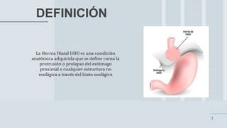 Hernia Hiatal PPT