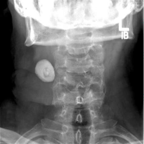 Pdf Giant Sialolith Of The Submandibular Salivary Gland Semantic