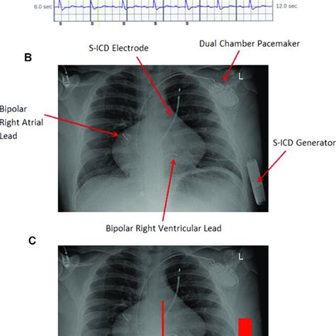 A A Captured Subcutaneous Implantable Cardioverter Defibrillator