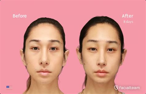 Eunsoo Before And After Ffs Surgery — Facialteam