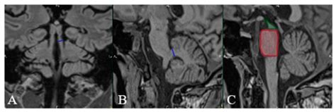 Diagnostics Free Full Text Imaging Criteria For The Diagnosis Of Progressive Supranuclear