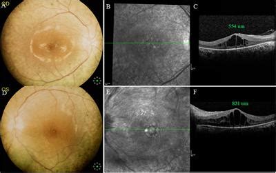 Frontiers Case Report A Case Of Cystoid Macular Edema In Retinitis