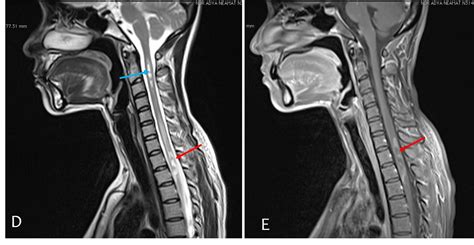 Neuromyelitis Optica Radiology Cases