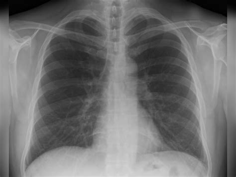 Us Fda Clears Dmedical S Lung Imaging Technology