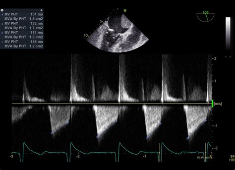 Transesophageal Echocardiography Mid Esophageal Long Axis View Of