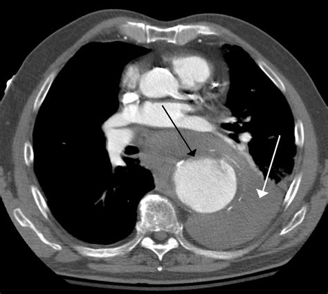 Thoracic Aortic Aneurysms Clinical Features Management Teachmesurgery