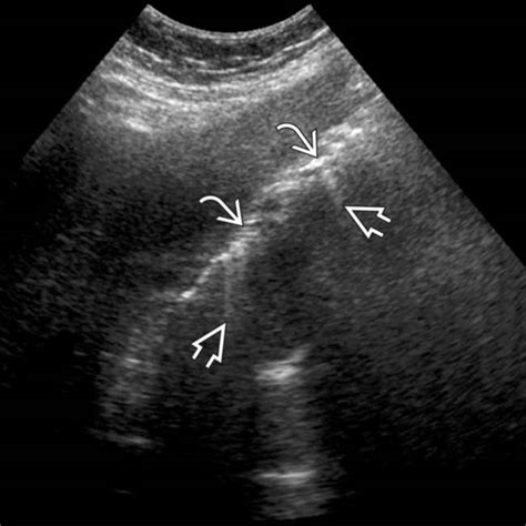 Emphysematous Cholecystitis Clinical Gate