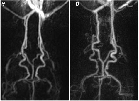 Time Resolved Angiography With Stochastic Trajectory Twist Download Scientific Diagram