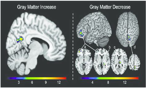 Significant Increase And Decrease In Gray Matter Over The Mindfulness