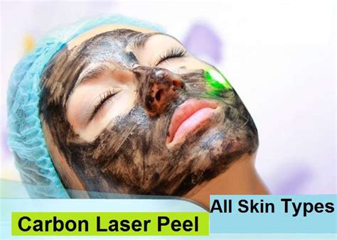 Laser carbon peeling of the face - Master Health