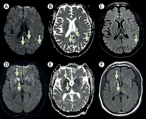 Biomarkers And Diagnostic Guidelines For Sporadic Creutzfeldt Jakob