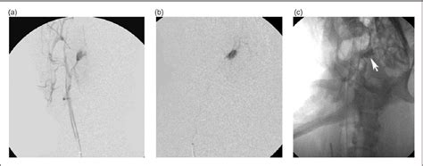 Figure 1 From Liquid Embolic Agent Fe3O4 EVOH For Endovascular