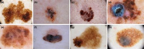 Dermoscopy Of Melanoma According To Different Body Sites Head And Neck