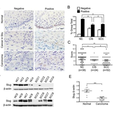 Expression Of Slug In Normal Cervix Samples And Various Cervical