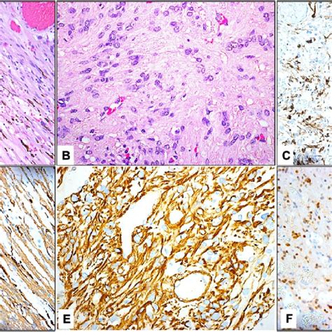 1a The Clinical Appearance Of The Dilated Scleral Sentinel Vessels In Download Scientific