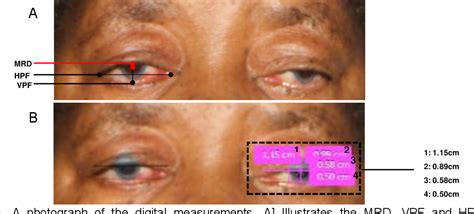 A Modular And Adjustable Ptosis Crutch As A Non Surgical Solution To