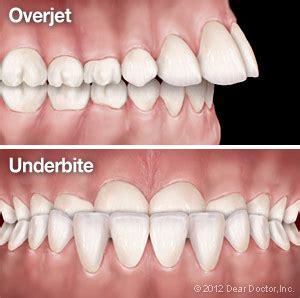 Overjet Vs Overbite