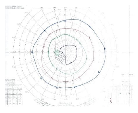 A B Left And Right Goldmann Visual Fields Showing Central