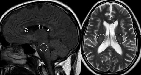 Diagnostic Criteria For Susac Syndrome Journal Of Neurology