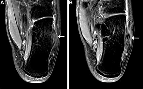 3 T Mri Of The Ankle Tendons And Ligaments Clinics In Sports Medicine