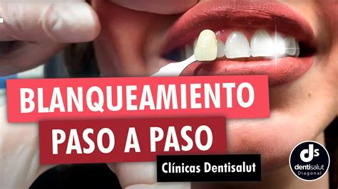 Blanqueamiento dental PASO A PASO Antes y después Clínica