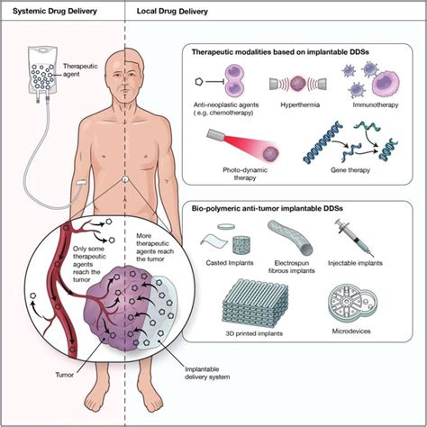 Schematic Of Systemic Drug Delivery Versus Local Drug Delivery For