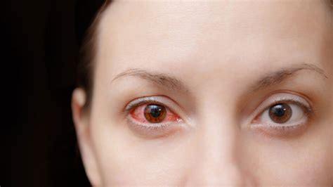 What Causes Pink Eye, and How Do You Get Rid of It? | Allure