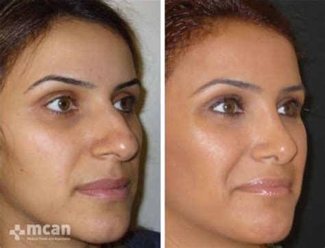 Rhinoplasty Turkey All Inclusive Nose Job In Turkey Cost