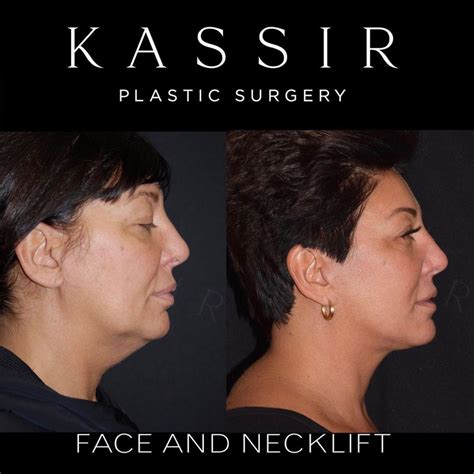 Facelift Patient Before And After — Kassir Plastic Surgery In Ny And Nj