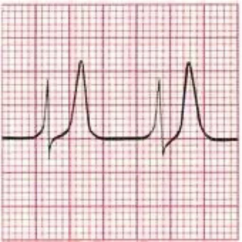 Ekg Miscellaneous Ischemia Flashcards Quizlet