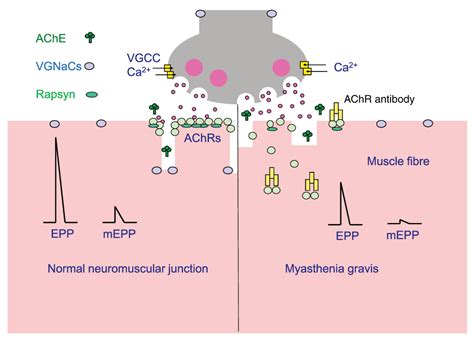 Neuromuscular Junction Myasthenia Gravis