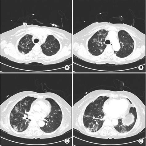 Chest Ct Scan Showing Multifocal Patchy Groundglass Opacities In Both