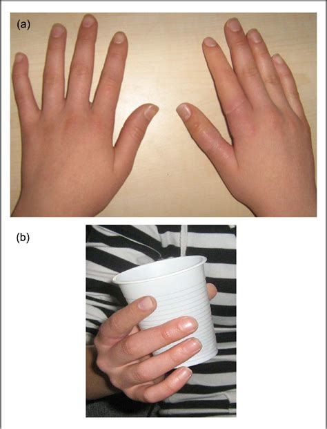 Figure 1 From Esthetic Functional And Prosthetic Outcomes With