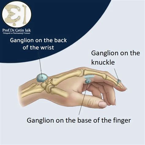 Ganglion Cyst In The Hand Symptoms And Treatment Dr Whats Wrong