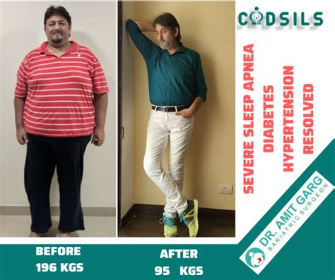 Bariatric Surgery Results Success Stories Dr Amit Garg