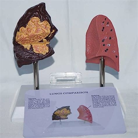 Smokers Lung Model Healthy Lung Model Life Size Human Lung Anatomy