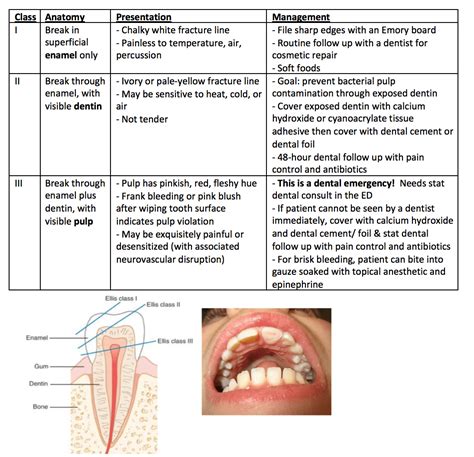 Types Of Teeth Fractures