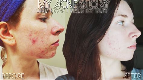 My Acne Story ♡ Skincare Routine For Acne And Products To Treat And Prevent