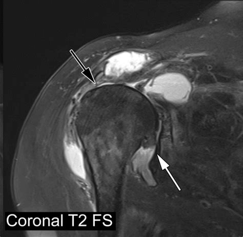 Mri Of Superior Capsular Reconstruction Radiographics