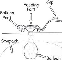 The gastrostomy button (G-button) | University of Iowa Health Care ...