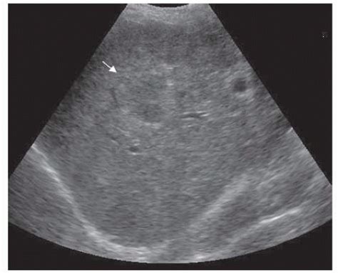 Intraoperative Ultrasound Of The Liver Basicmedical Key