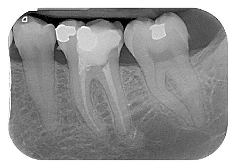 Successful Endodontic Retreatment Of 36 Symptomatic With Root