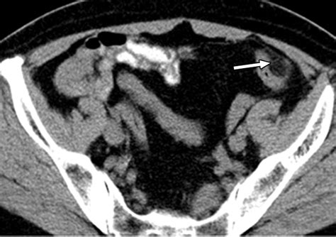 Epiploic Appendagitis An Entity Frequently Unknown To Clinicians